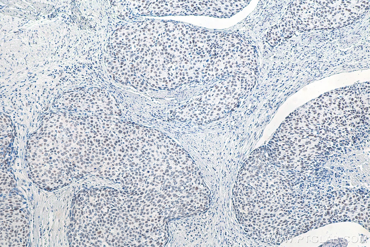 Immunohistochemical analysis of paraffin-embedded human oesophagus cancer tissue slide using KHC0061 (METTL3 IHC Kit).