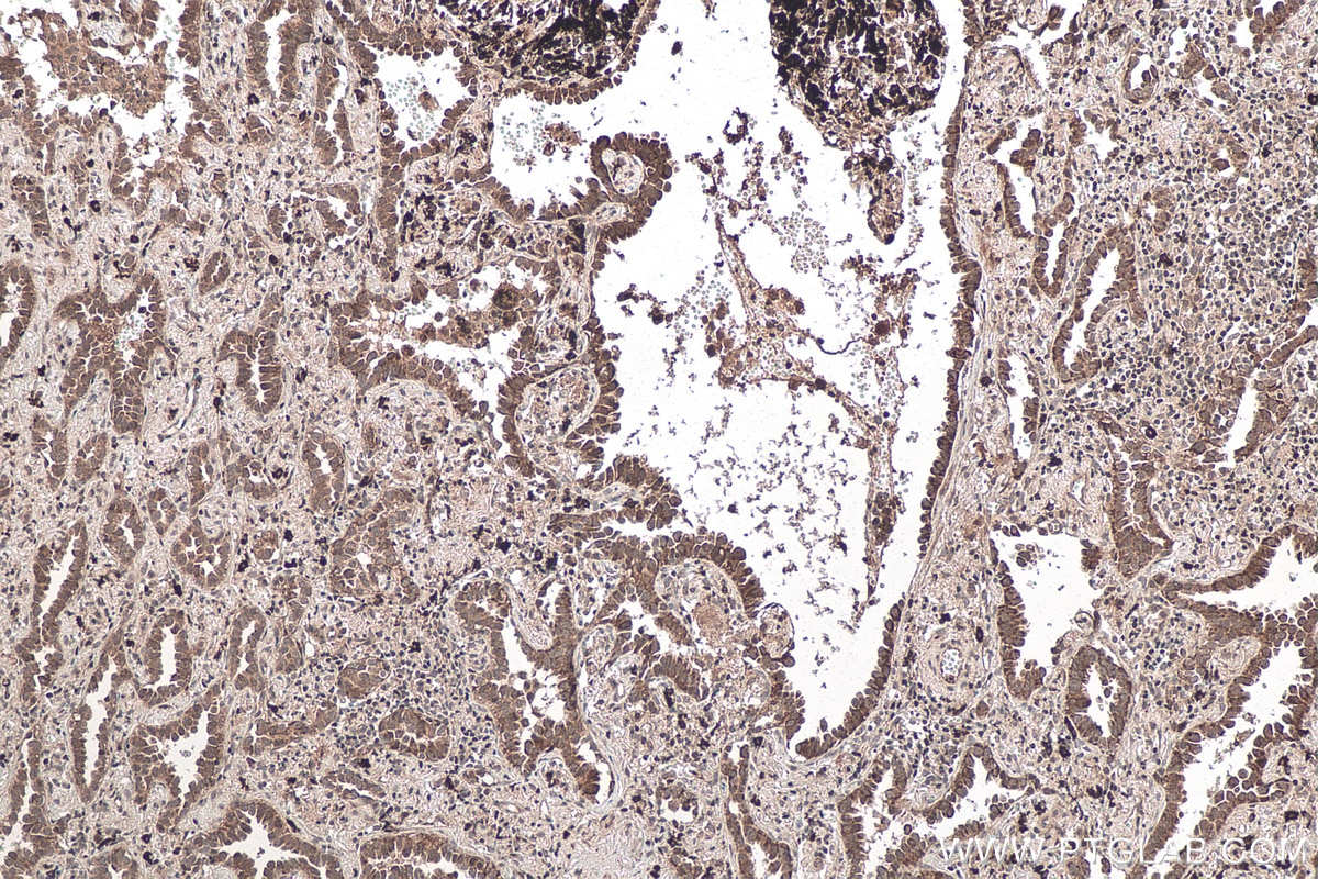 Immunohistochemical analysis of paraffin-embedded human lung cancer tissue slide using KHC0147 (METTL5 IHC Kit).