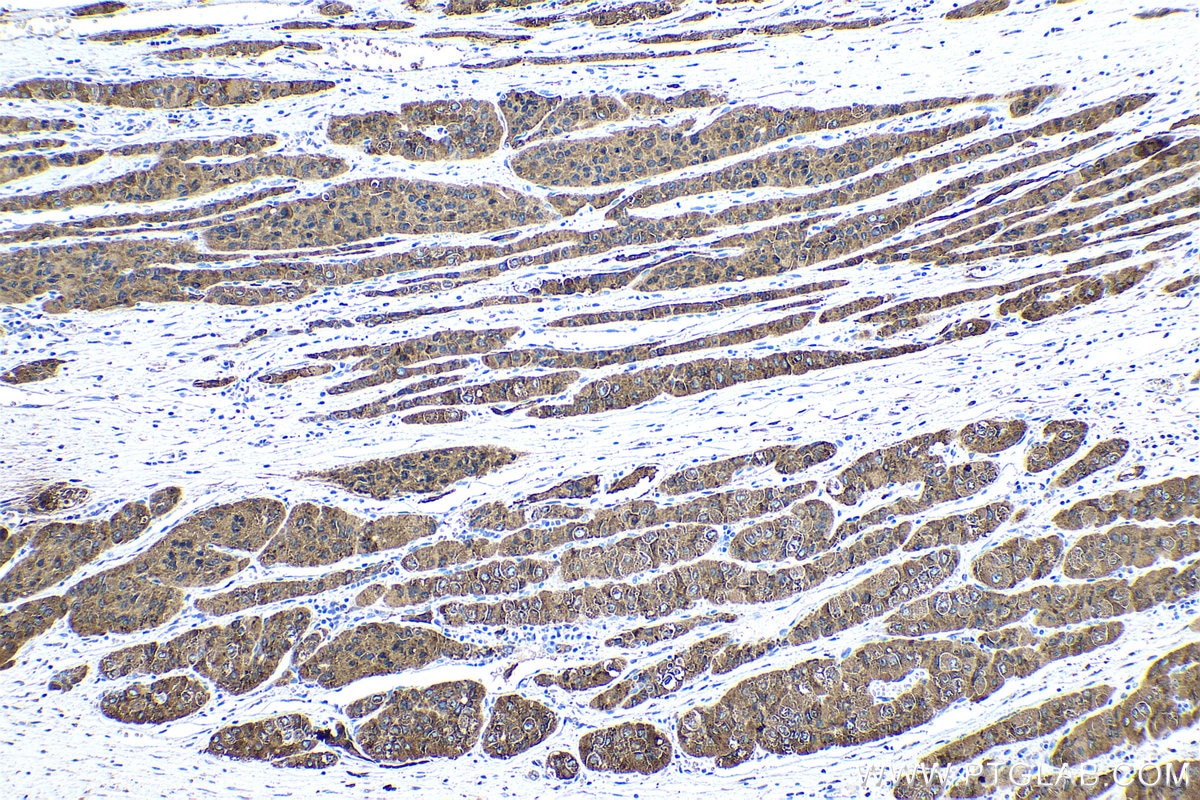 Immunohistochemical analysis of paraffin-embedded human liver cancer tissue slide using KHC0532 (METTL7A IHC Kit).