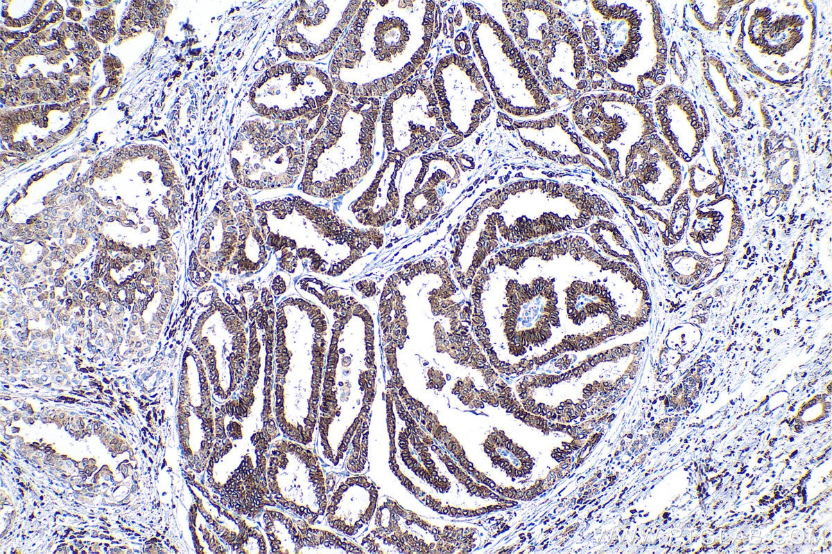 Immunohistochemical analysis of paraffin-embedded human thyroid cancer tissue slide using KHC0532 (METTL7A IHC Kit).