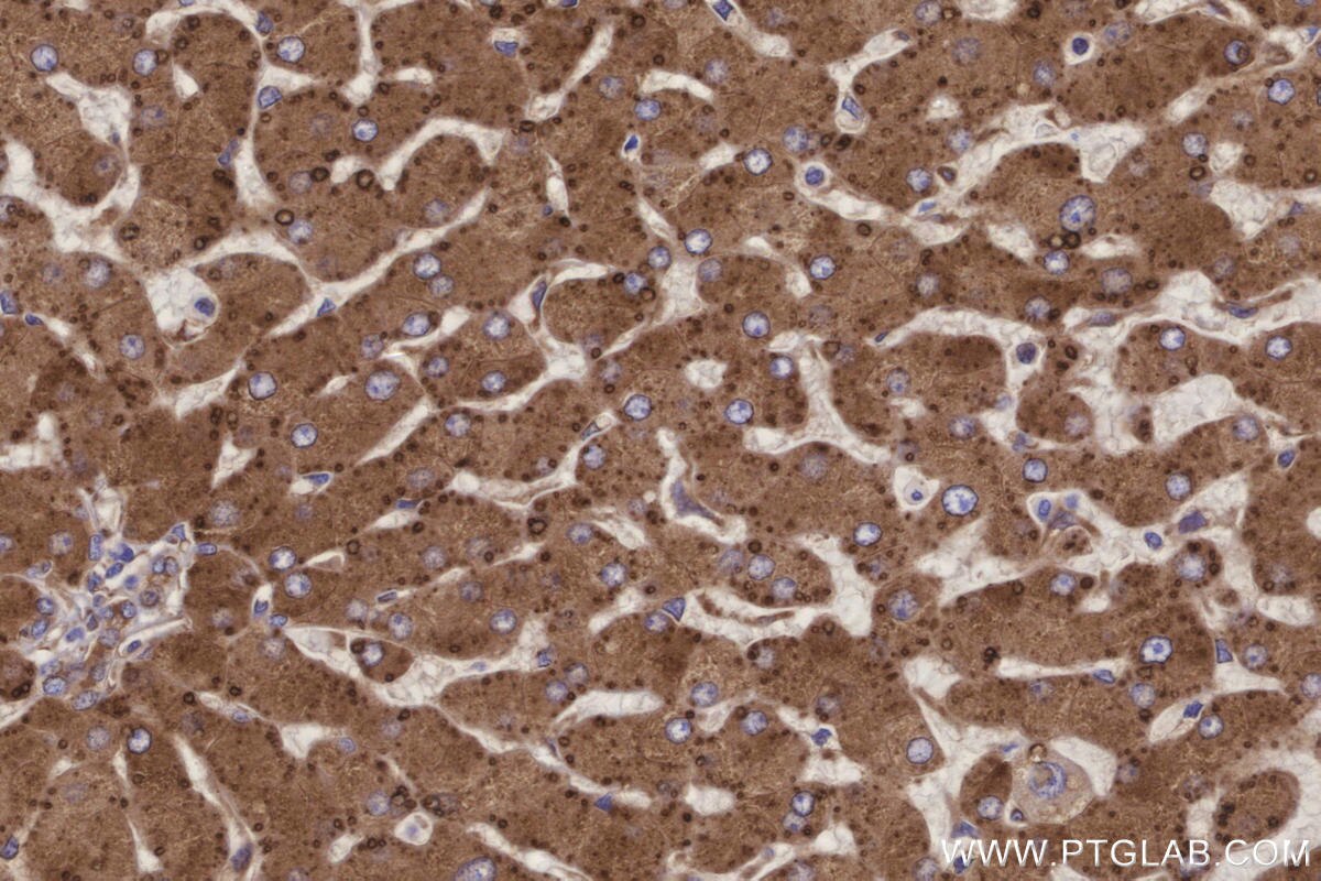 Immunohistochemical analysis of paraffin-embedded human hepatocirrhosis tissue slide using KHC3275 (METTL7B IHC Kit).