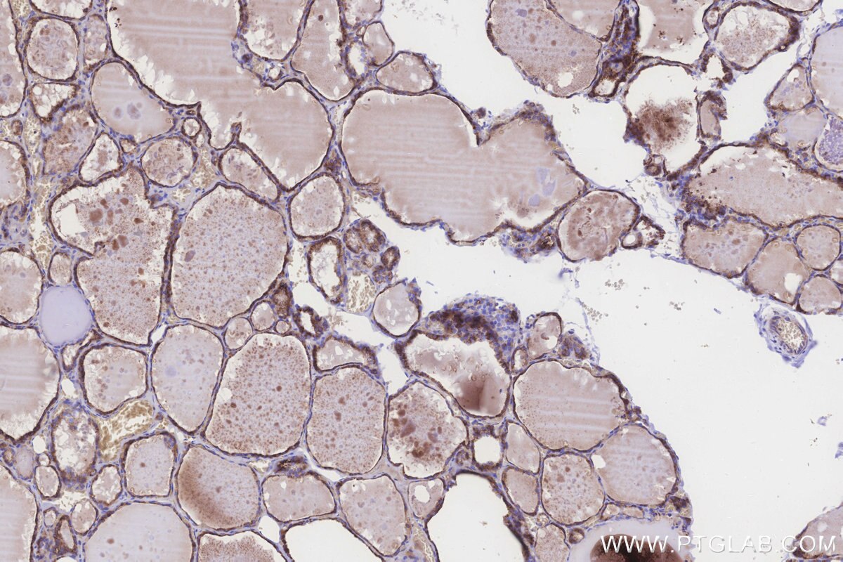 Immunohistochemical analysis of paraffin-embedded human thyroid cancer tissue slide using KHC3248 (MGAT2 IHC Kit). Immunohistochemical analysis of paraffin-embedded human thyroid cancer tissue slide using KHC3248 (MGAT2 IHC Kit).