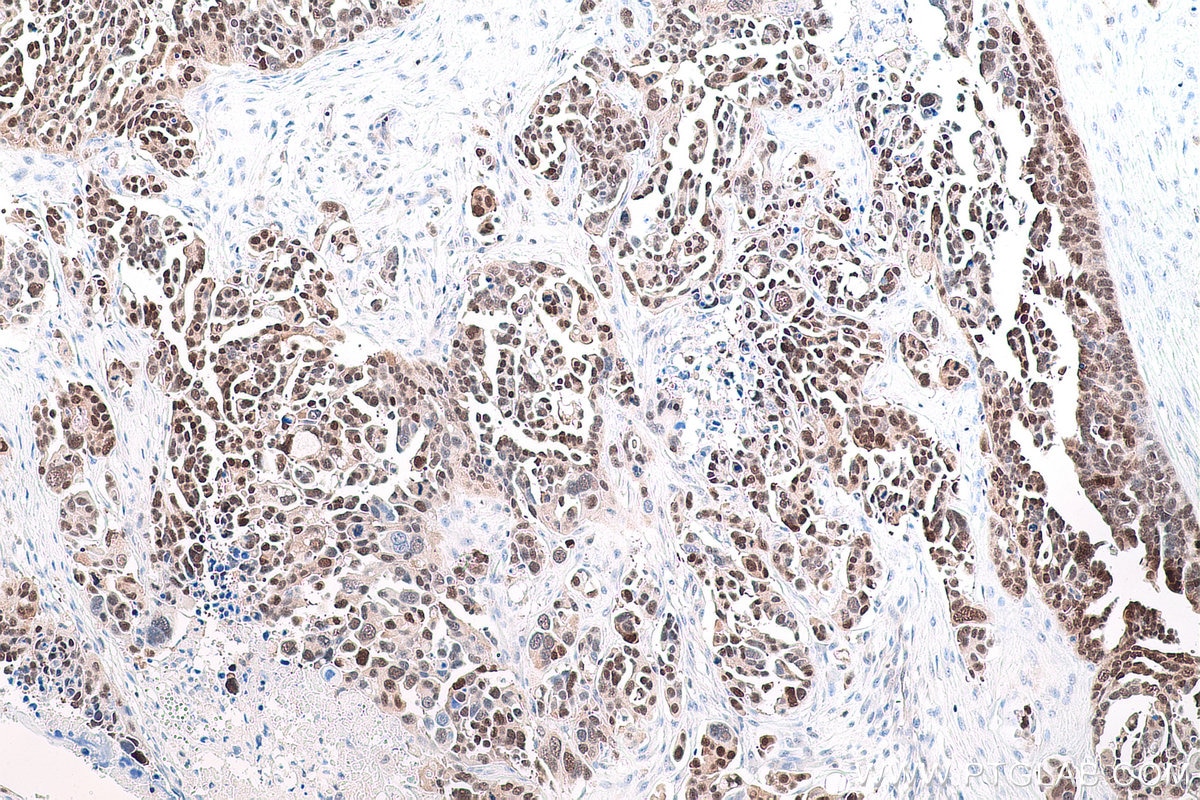 Immunohistochemical analysis of paraffin-embedded human colon cancer tissue slide using KHC0771 (MGMT IHC Kit).