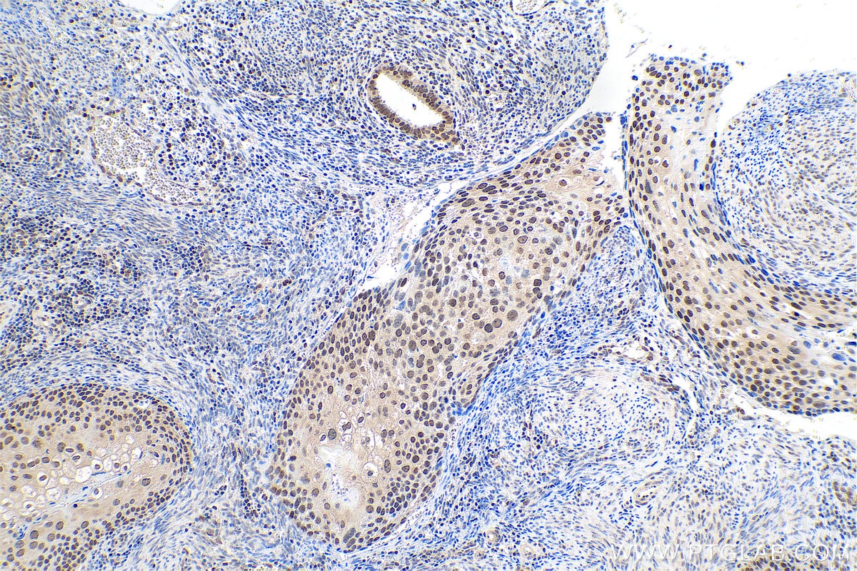 Immunohistochemical analysis of paraffin-embedded human cervical cancer tissue slide using KHC0771 (MGMT IHC Kit).