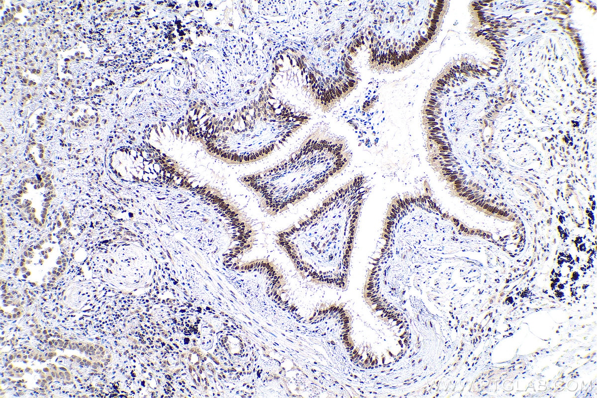 Immunohistochemical analysis of paraffin-embedded human lung cancer tissue slide using KHC0771 (MGMT IHC Kit).