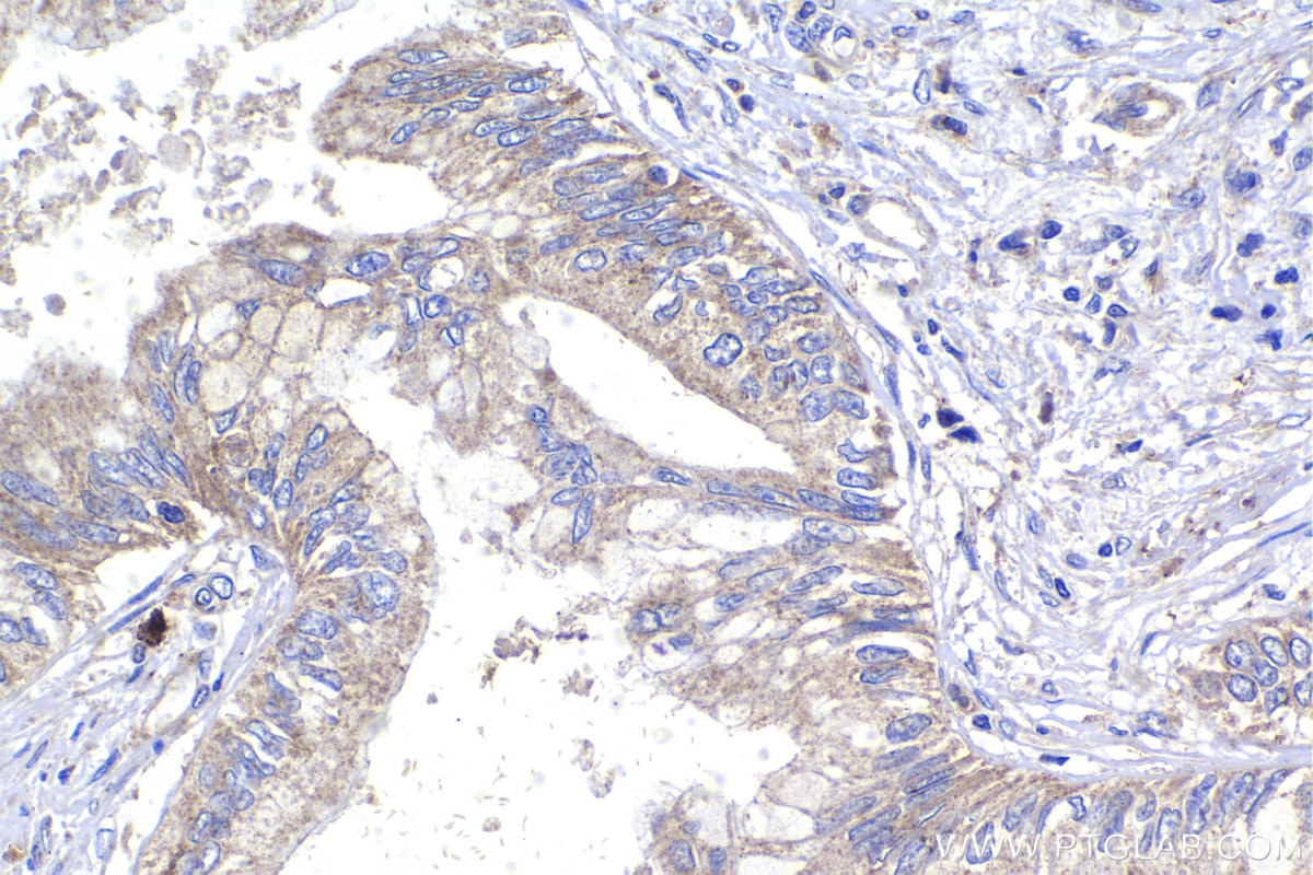 Immunohistochemical analysis of paraffin-embedded human pancreas cancer tissue slide using KHC1484 (MICAL2 IHC Kit).