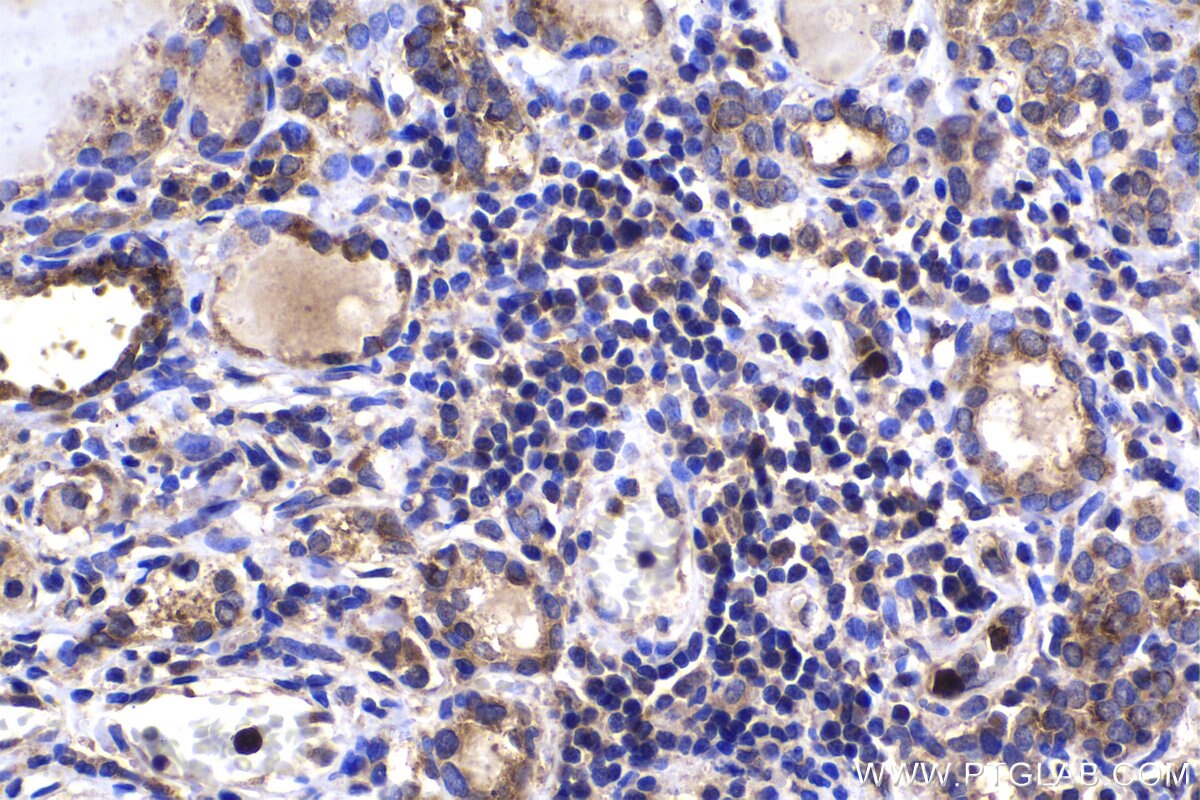 Immunohistochemical analysis of paraffin-embedded human thyroid cancer tissue slide using KHC1484 (MICAL2 IHC Kit).
