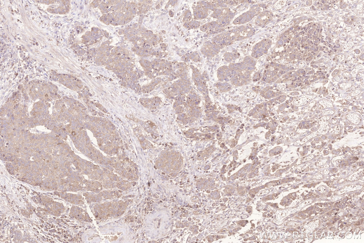 Immunohistochemical analysis of paraffin-embedded human stomach cancer tissue slide using KHC3277 (MIGA2/FAM73B IHC Kit).