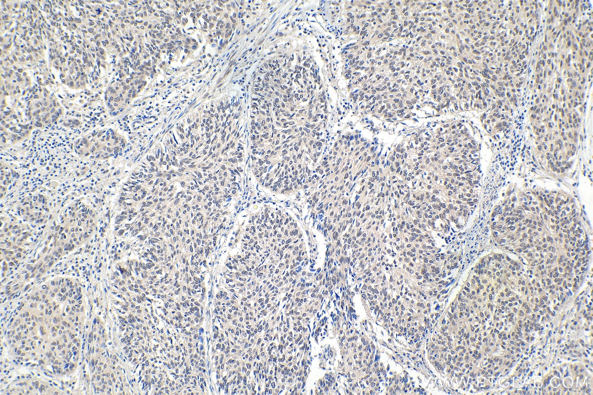 Immunohistochemical analysis of paraffin-embedded human cervical cancer tissue slide using KHC1634 (MLF1 IHC Kit).