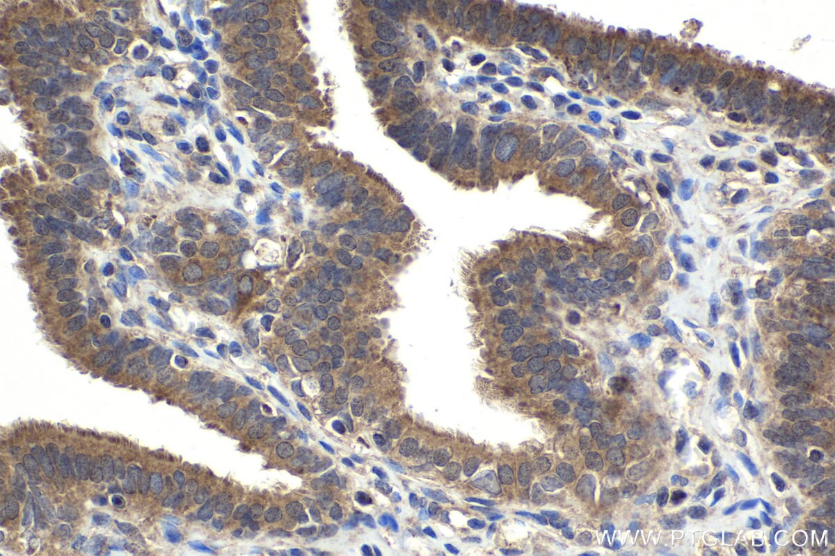 Immunohistochemical analysis of paraffin-embedded human ovary tumor tissue slide using KHC1940 (MLXIP IHC Kit).