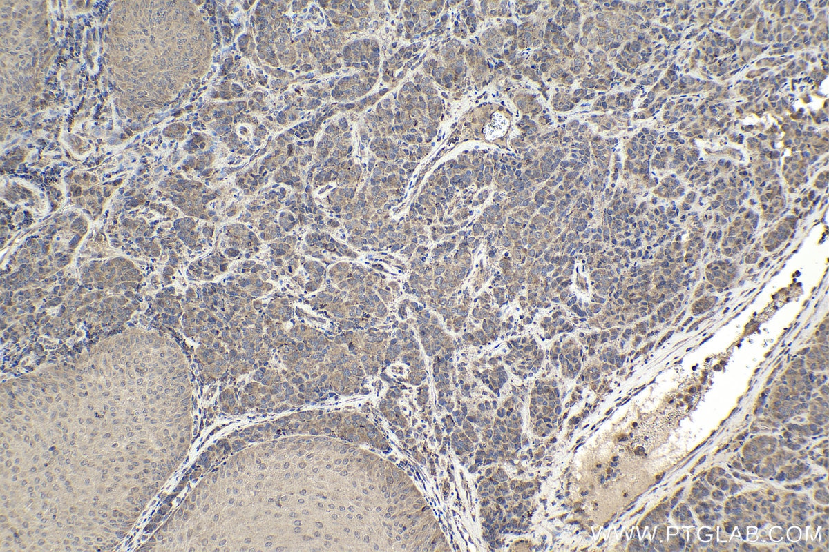 Immunohistochemical analysis of paraffin-embedded human malignant melanoma tissue slide using KHC1940 (MLXIP IHC Kit).