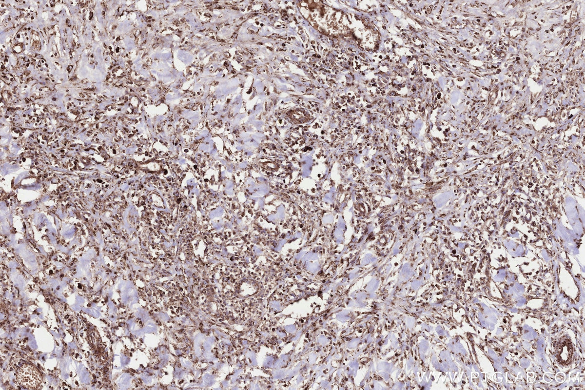 Immunohistochemical analysis of paraffin-embedded human colon cancer tissue slide using KHC3289 (MMGT1 IHC Kit).