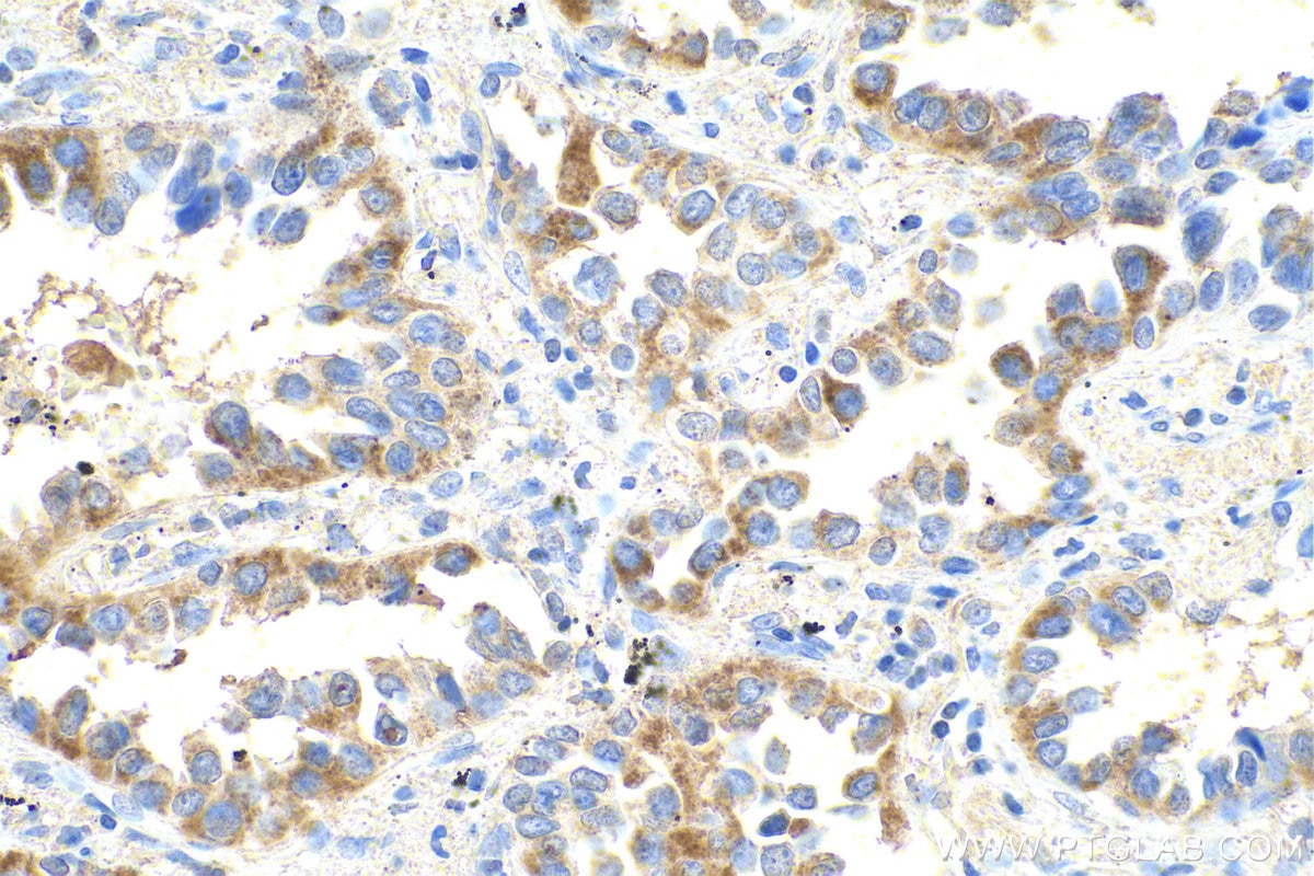 Immunohistochemical analysis of paraffin-embedded human lung cancer tissue slide using KHC0804 (MMP1 IHC Kit).