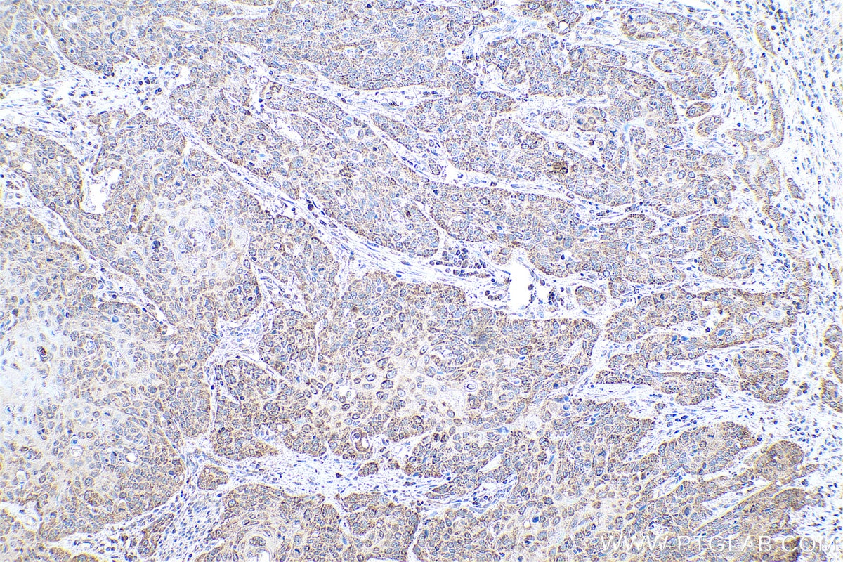 Immunohistochemical analysis of paraffin-embedded human oesophagus cancer tissue slide using KHC0804 (MMP1 IHC Kit).