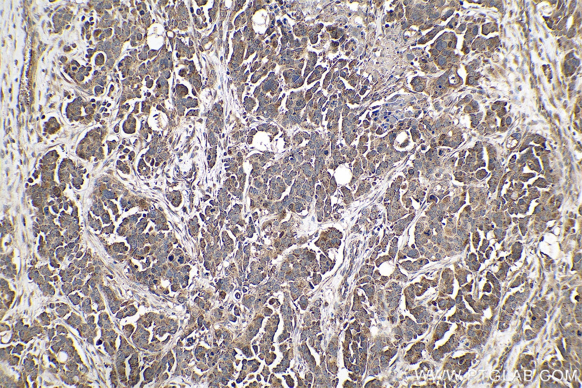 Immunohistochemical analysis of paraffin-embedded human colon cancer tissue slide using KHC0785 (MMP12 IHC Kit).
