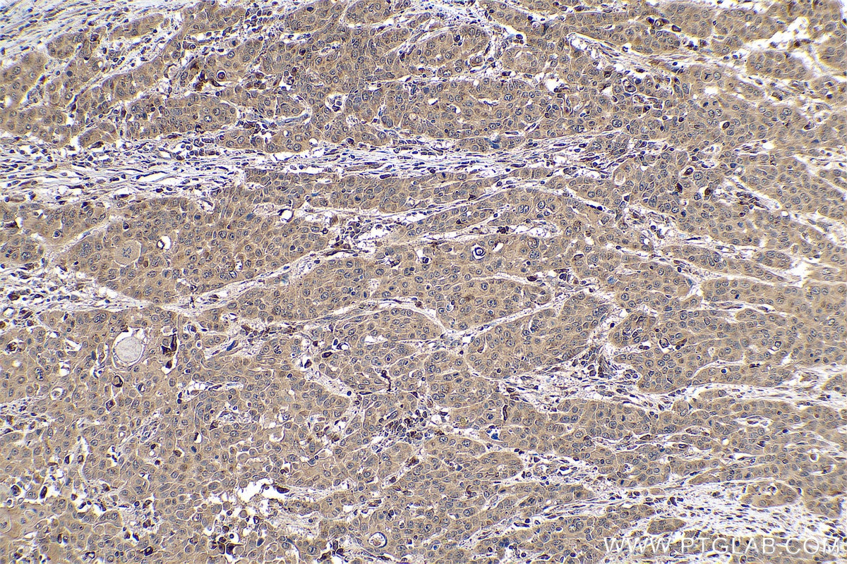 Immunohistochemical analysis of paraffin-embedded human oesophagus cancer tissue slide using KHC0785 (MMP12 IHC Kit).