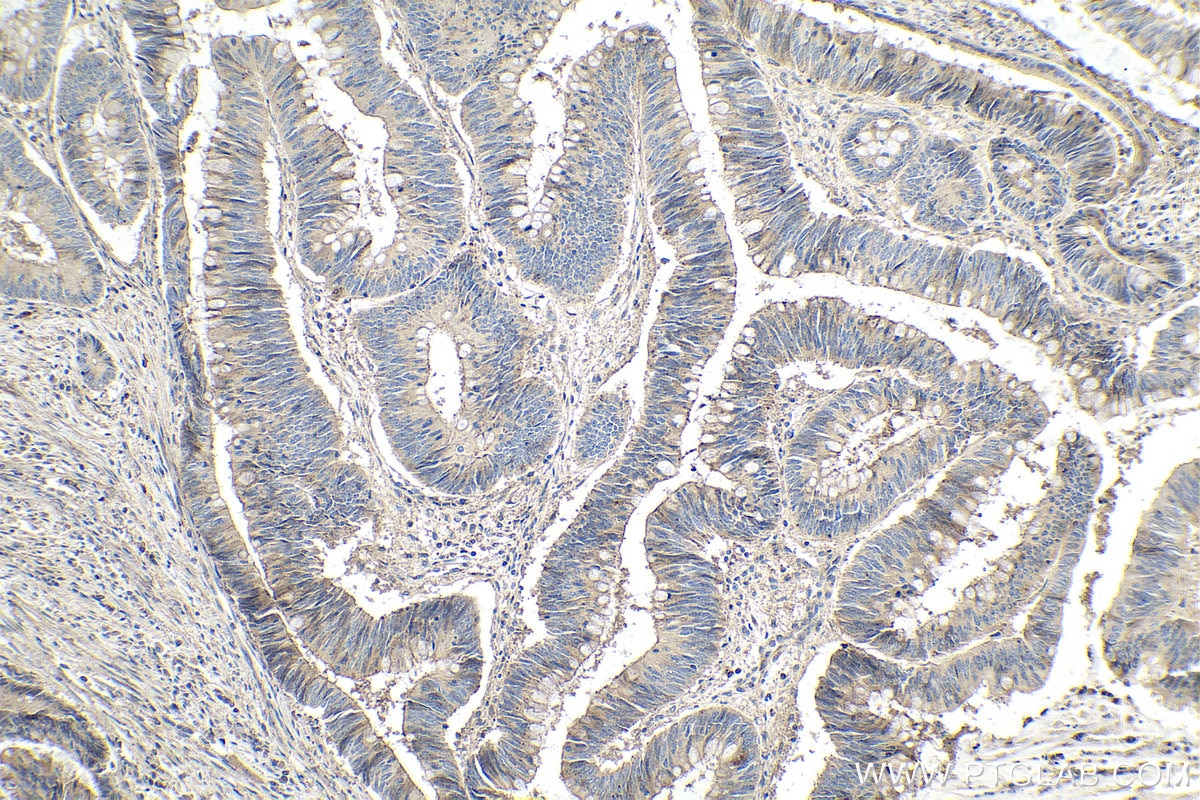 Immunohistochemical analysis of paraffin-embedded human colon cancer tissue slide using KHC0109 (MMP3 IHC Kit).