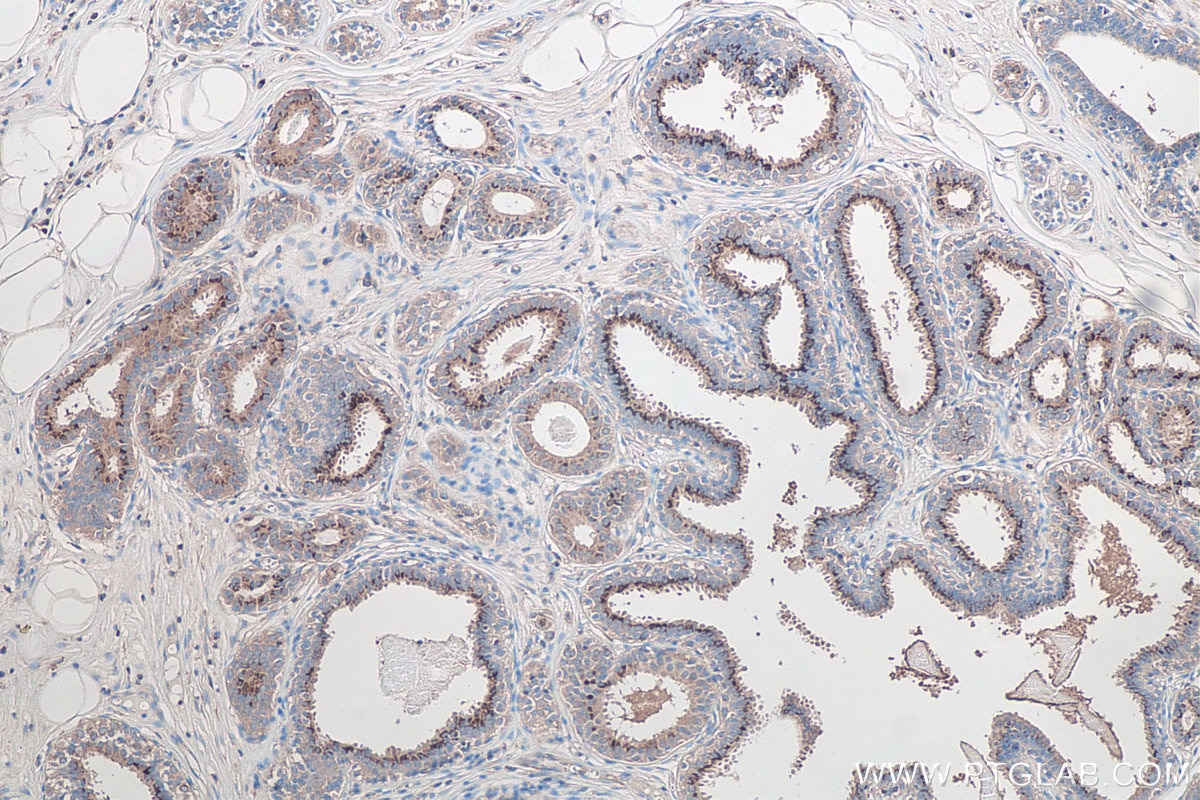 Immunohistochemical analysis of paraffin-embedded human breast cancer tissue slide using KHC0109 (MMP3 IHC Kit).