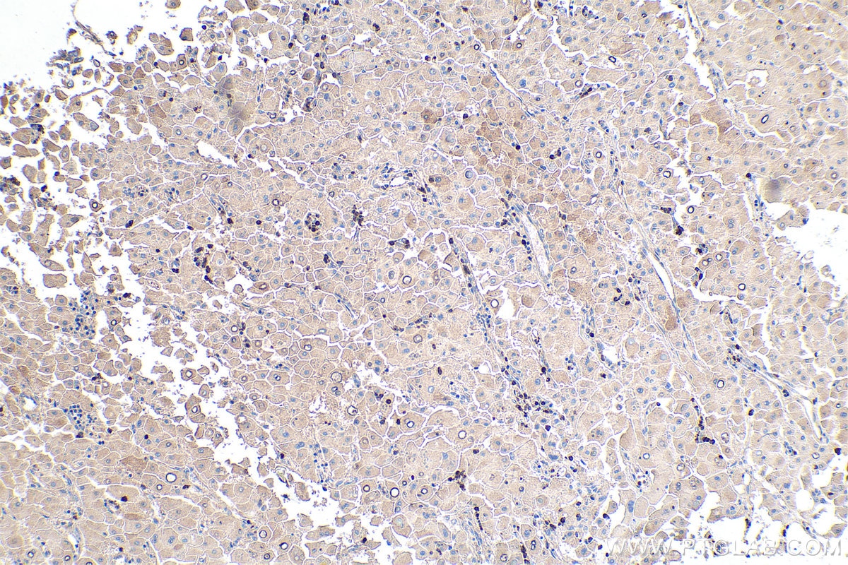 Immunohistochemical analysis of paraffin-embedded human liver cancer tissue slide using KHC0120 (MMP9 IHC Kit).