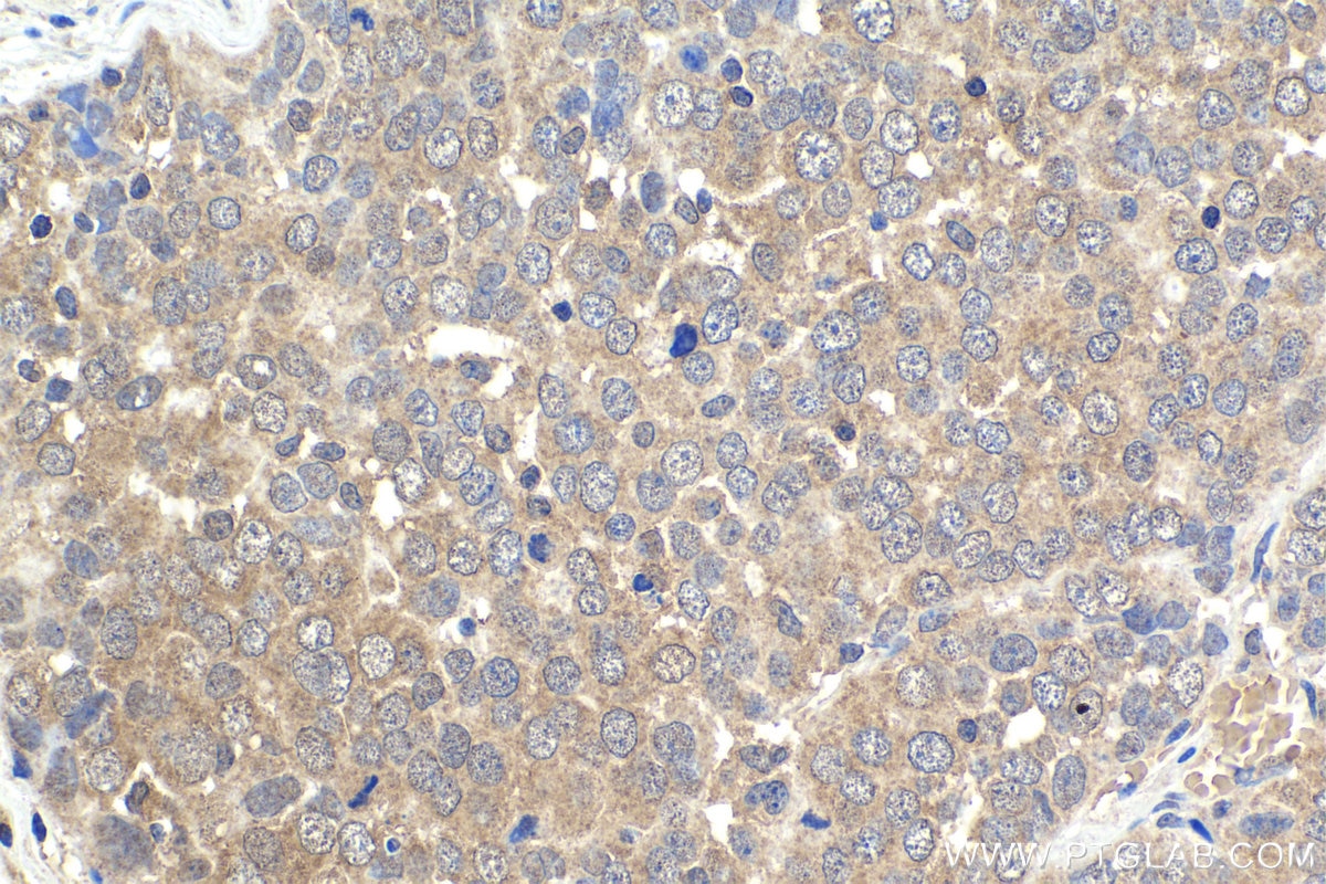 Immunohistochemical analysis of paraffin-embedded human ovary tumor tissue slide using KHC1886 (MMS19 IHC Kit).
