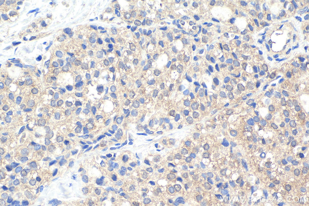 Immunohistochemical analysis of paraffin-embedded human thyroid cancer tissue slide using KHC1886 (MMS19 IHC Kit).