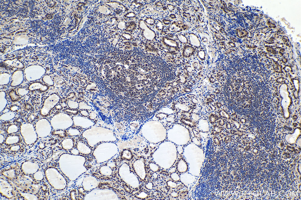 Immunohistochemical analysis of paraffin-embedded human thyroid cancer tissue slide using KHC1620 (MNAT1 IHC Kit).