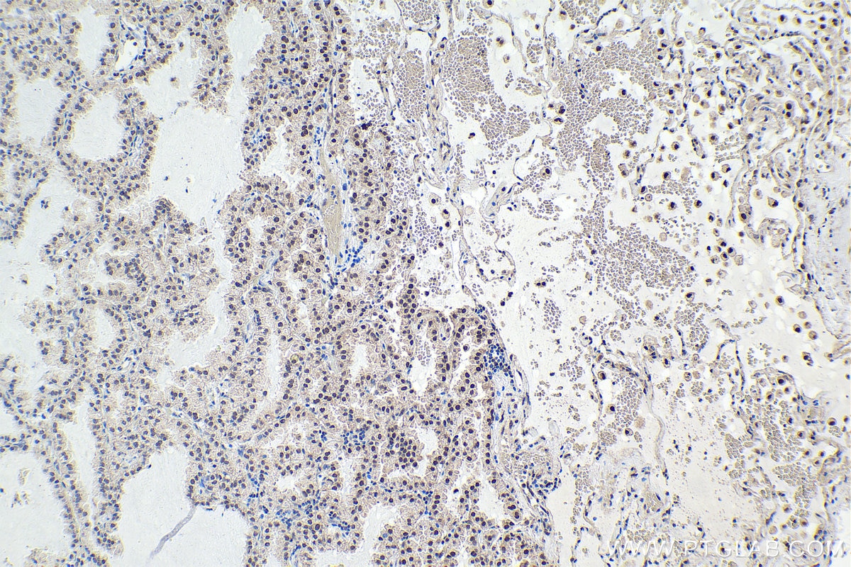 Immunohistochemical analysis of paraffin-embedded human lung cancer tissue slide using KHC1620 (MNAT1 IHC Kit).