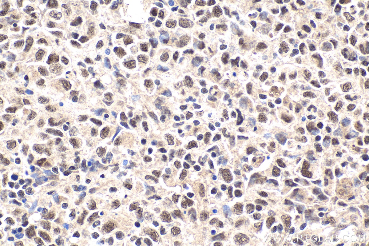 Immunohistochemical analysis of paraffin-embedded human malignant melanoma tissue slide using KHC1892 (MNT IHC Kit).