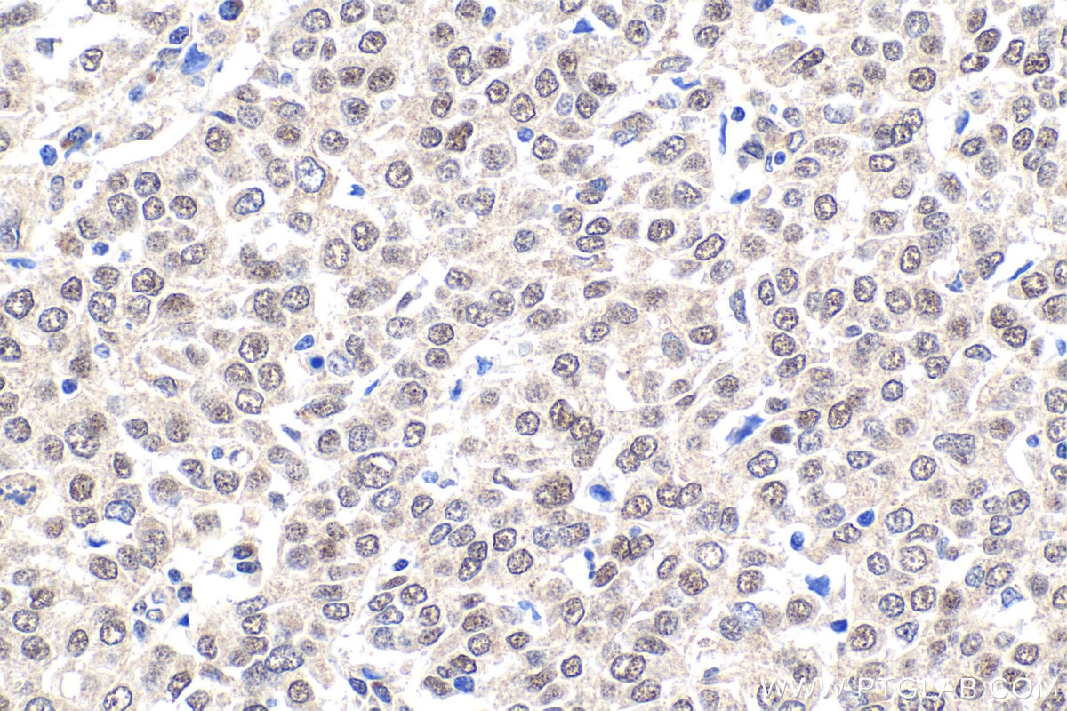 Immunohistochemical analysis of paraffin-embedded human ovary tumor tissue slide using KHC1892 (MNT IHC Kit).