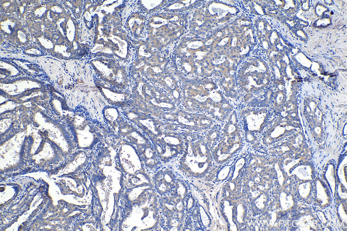 Immunohistochemical analysis of paraffin-embedded human breast cancer tissue slide using KHC1401 (MOAP1 IHC Kit).