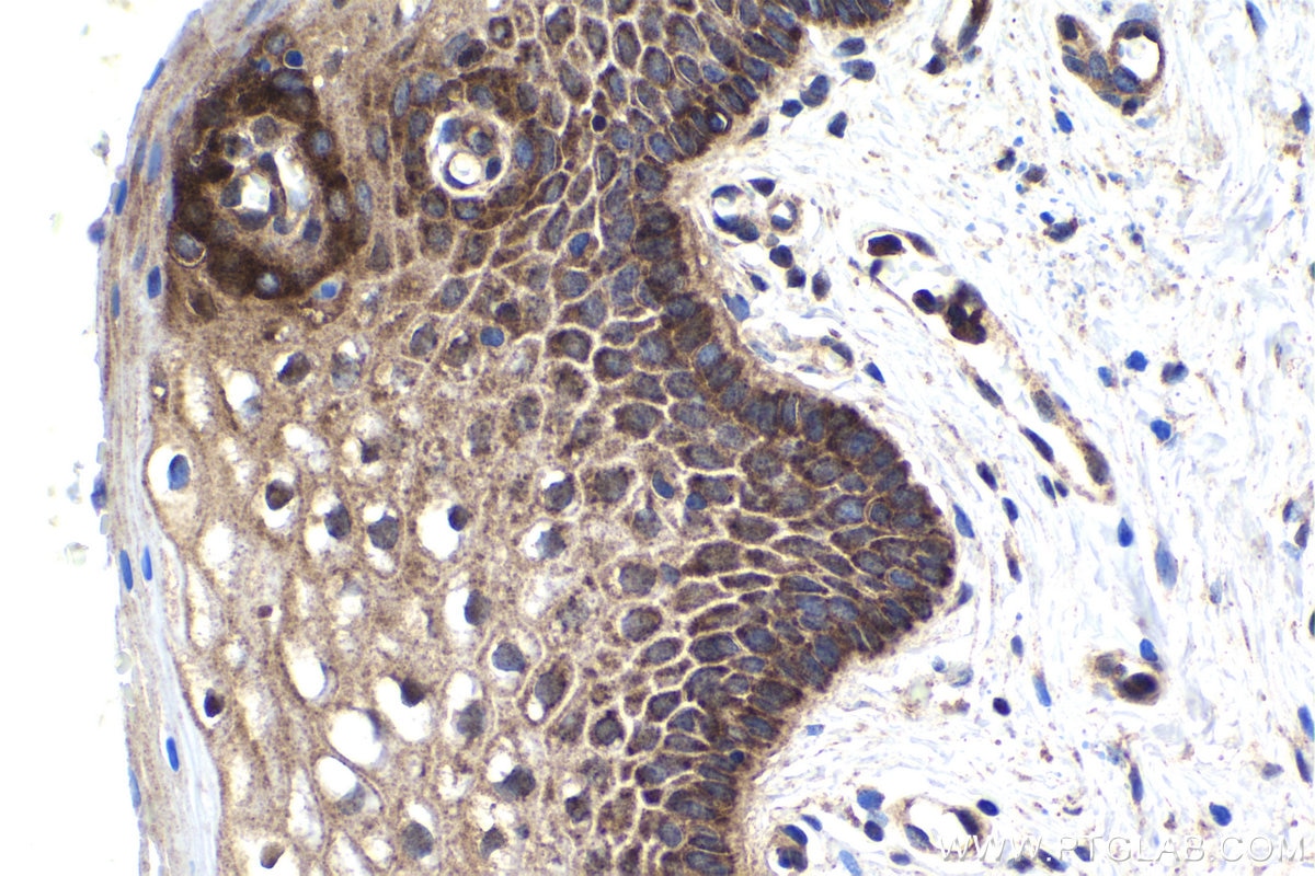 Immunohistochemical analysis of paraffin-embedded human cervical cancer tissue slide using KHC1946 (MOV10 IHC Kit).