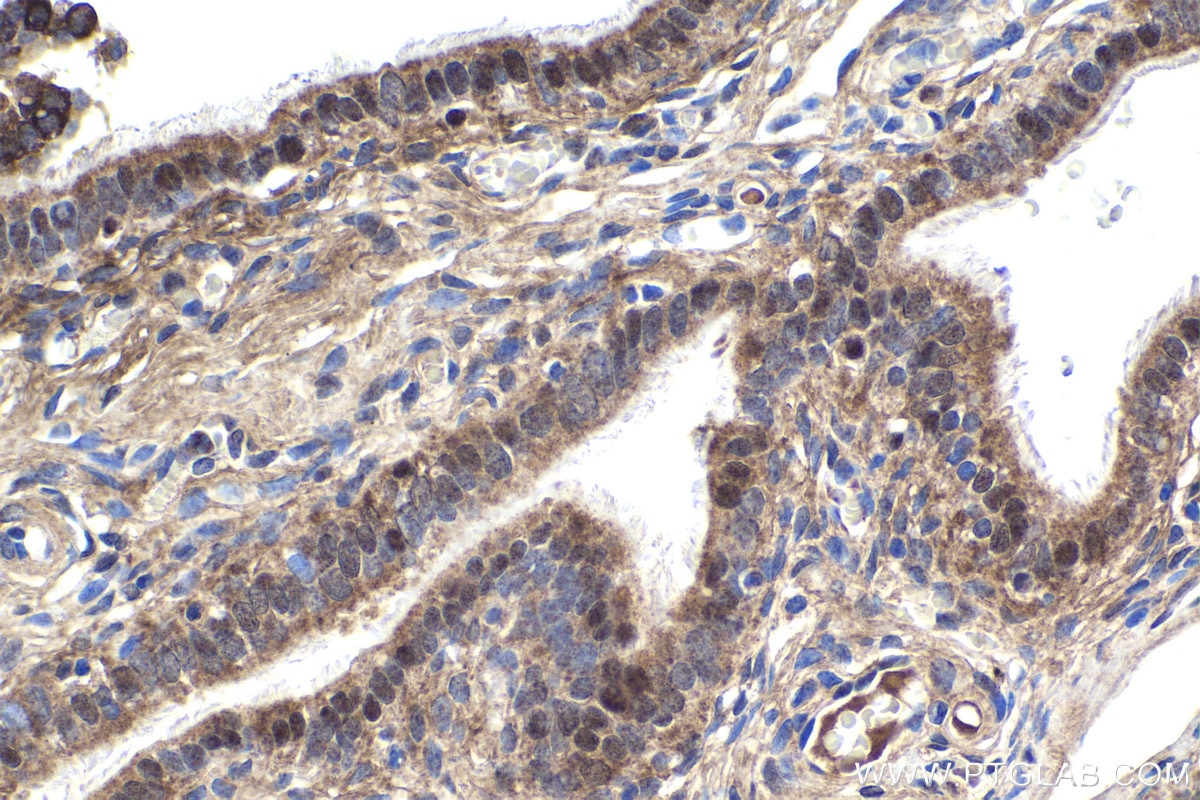Immunohistochemical analysis of paraffin-embedded human ovary tumor tissue slide using KHC1946 (MOV10 IHC Kit).
