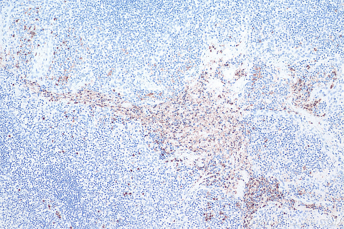 Immunohistochemical analysis of paraffin-embedded human tonsillitis tissue slide using KHC0040 (MPO IHC Kit).