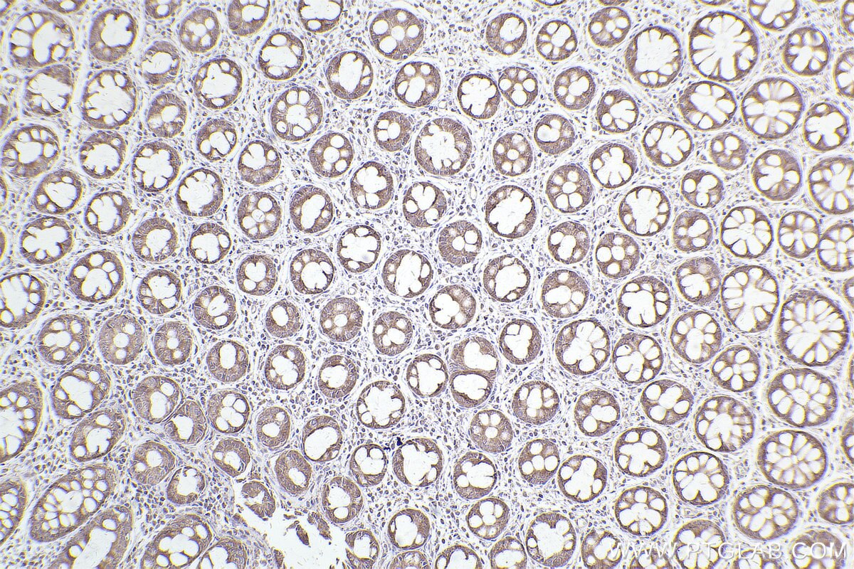 Immunohistochemical analysis of paraffin-embedded human rectal cancer tissue slide using KHC2551 (MPP7 IHC Kit).