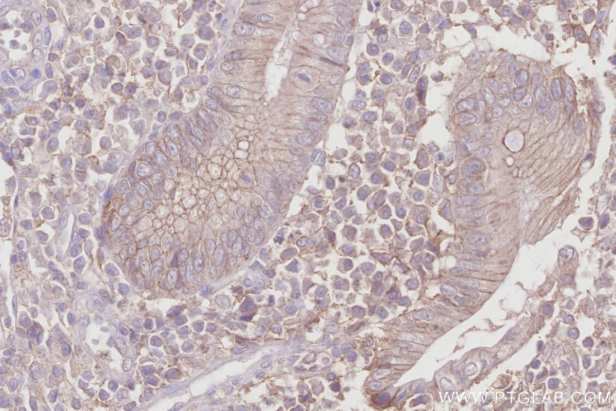 Immunohistochemical analysis of paraffin-embedded human appendicitis tissue slide using KHC2758 (MRP1/ABCC1 IHC Kit).