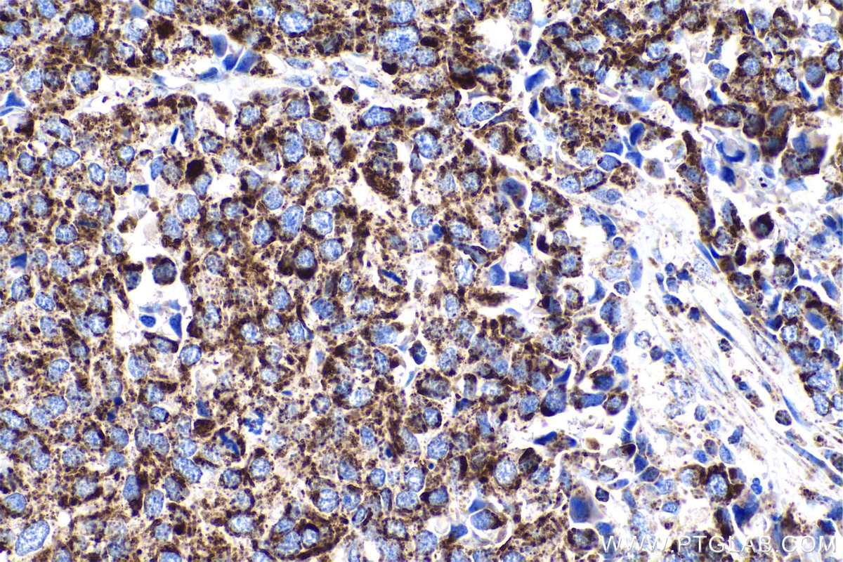 Immunohistochemical analysis of paraffin-embedded human stomach cancer tissue slide using KHC0893 (MRPL12 IHC Kit).