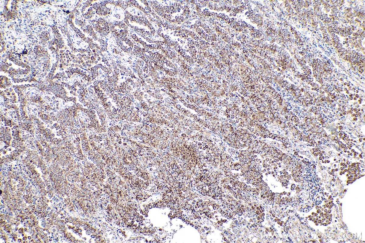 Immunohistochemical analysis of paraffin-embedded human lung cancer tissue slide using KHC0893 (MRPL12 IHC Kit).