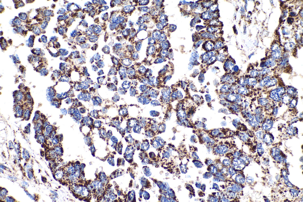 Immunohistochemical analysis of paraffin-embedded human colon cancer tissue slide using KHC0893 (MRPL12 IHC Kit).