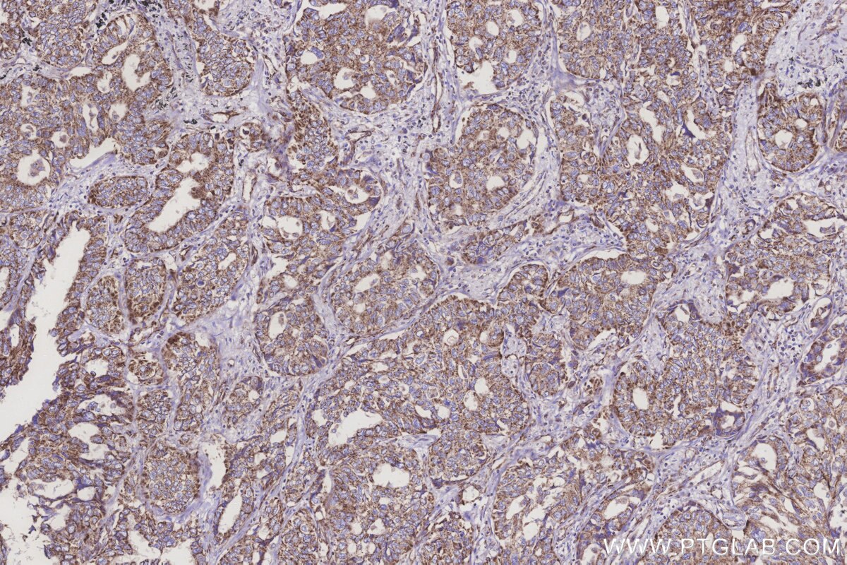 Immunohistochemical analysis of paraffin-embedded human lung cancer tissue slide using KHC3249 (MRPL28 IHC Kit).