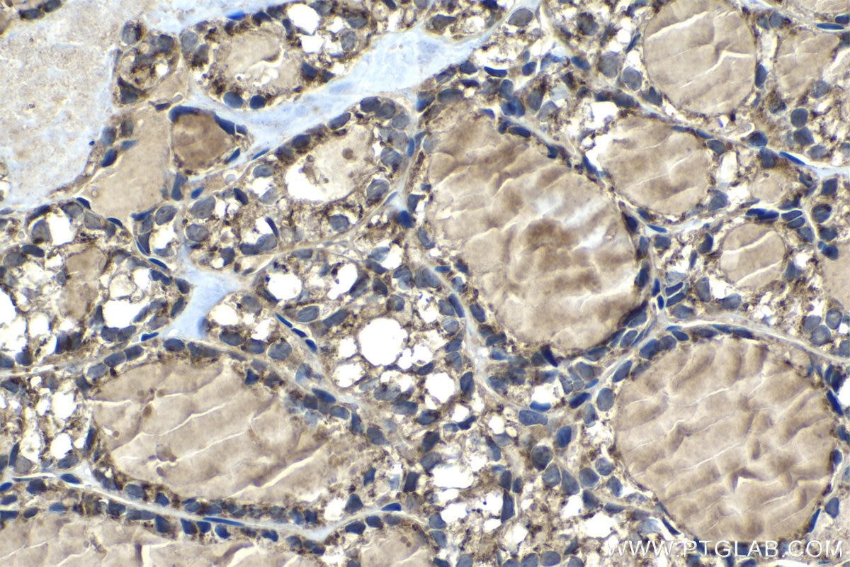Immunohistochemical analysis of paraffin-embedded human thyroid cancer tissue slide using KHC1315 (MRPL3 IHC Kit).