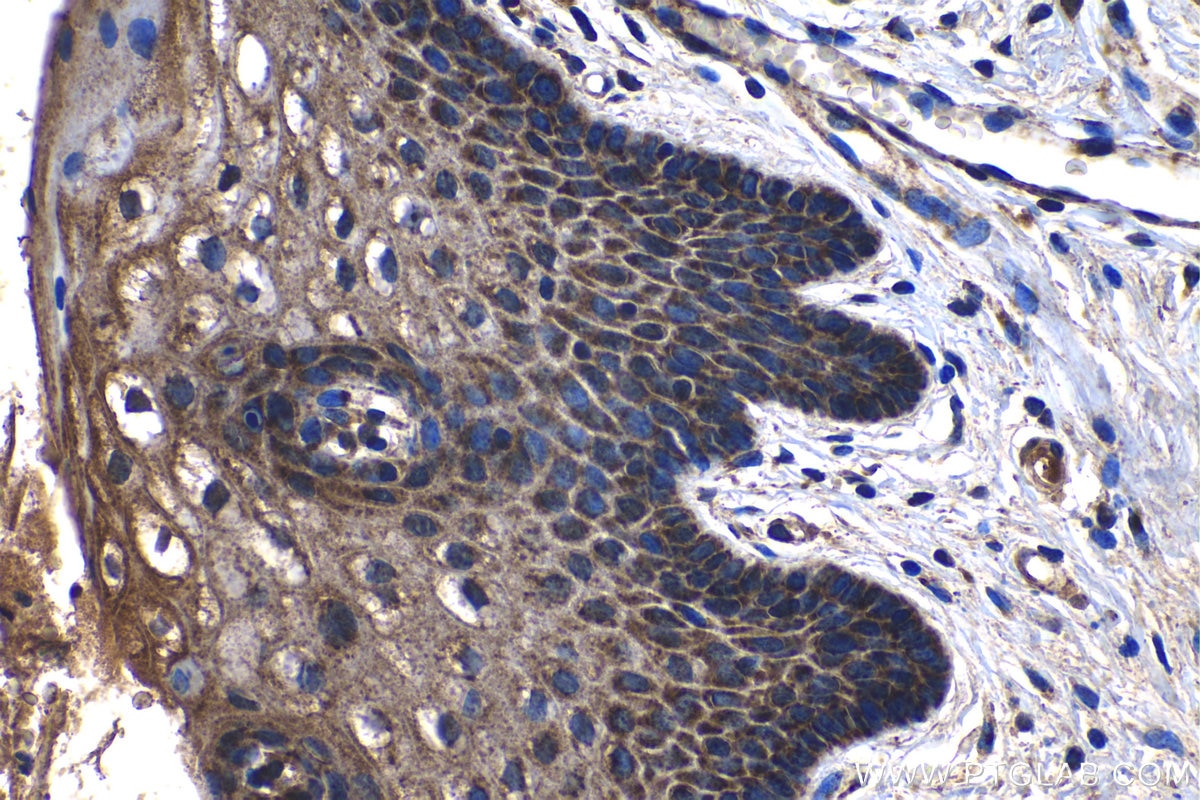 Immunohistochemical analysis of paraffin-embedded human cervical cancer tissue slide using KHC1315 (MRPL3 IHC Kit).