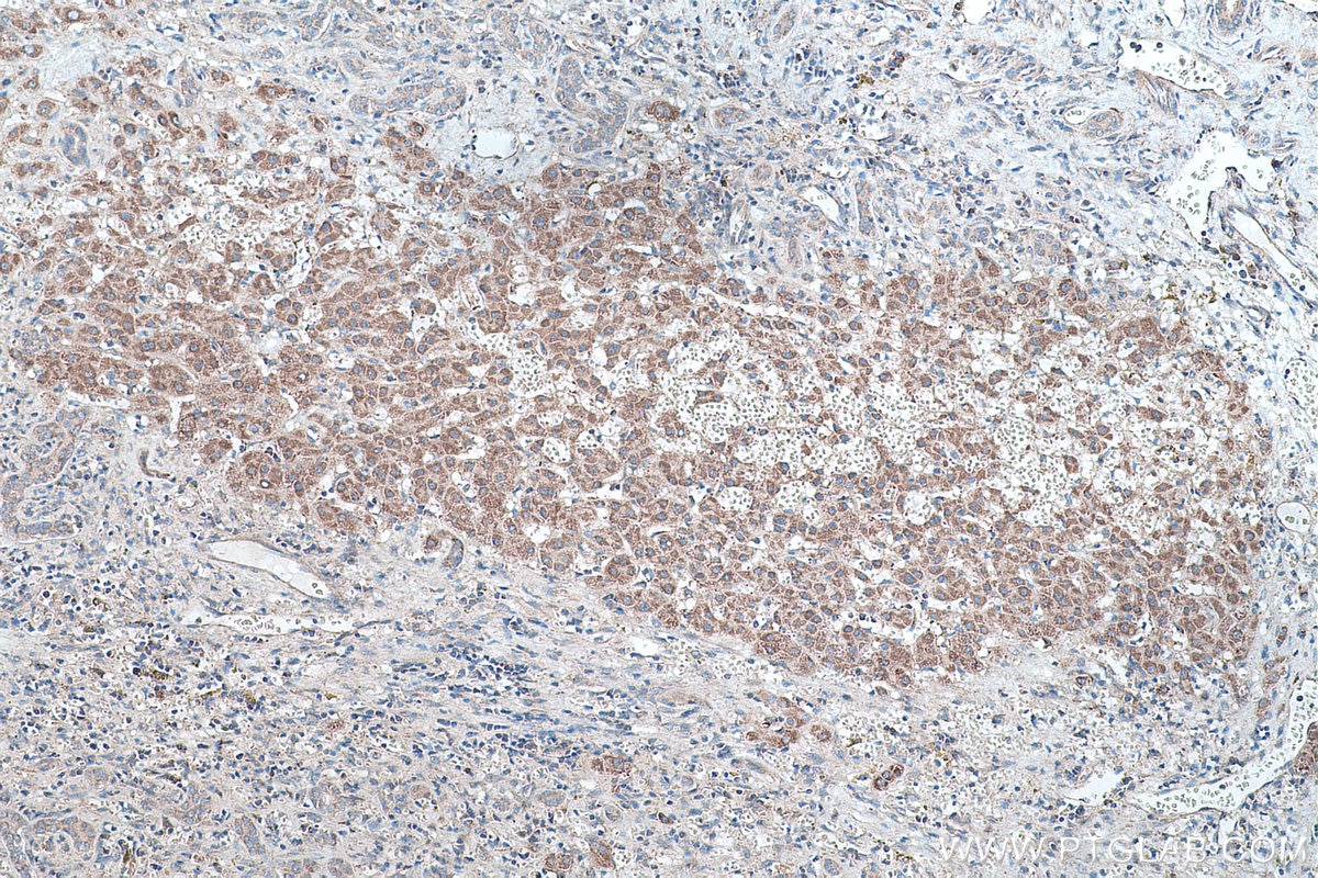 Immunohistochemical analysis of paraffin-embedded human liver cancer tissue slide using KHC0436 (MRPL33 IHC Kit).
