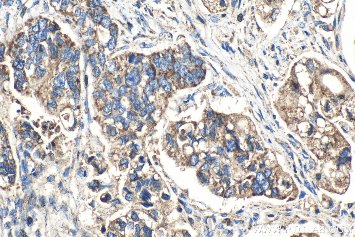 Immunohistochemical analysis of paraffin-embedded human stomach cancer tissue slide using KHC1408 (MRPL42 IHC Kit).