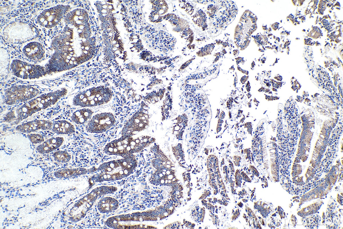 Immunohistochemical analysis of paraffin-embedded human stomach cancer tissue slide using KHC1365 (MRPL49 IHC Kit).