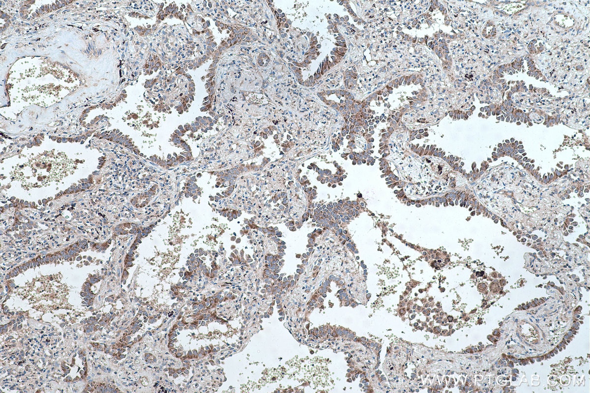 Immunohistochemical analysis of paraffin-embedded human lung cancer tissue slide using KHC0437 (MRPS28 IHC Kit).
