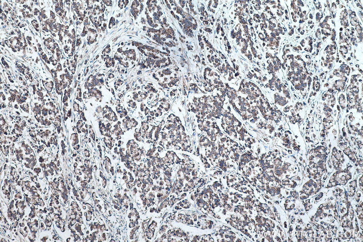Immunohistochemical analysis of paraffin-embedded human colon cancer tissue slide using KHC0437 (MRPS28 IHC Kit).