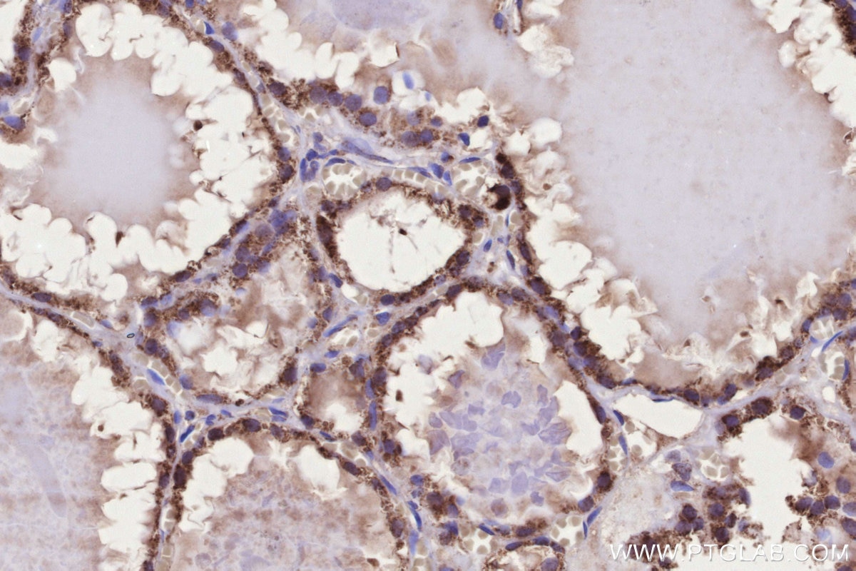 Immunohistochemical analysis of paraffin-embedded human thyroid cancer tissue slide using KHC3306 (MRPS31 IHC Kit).