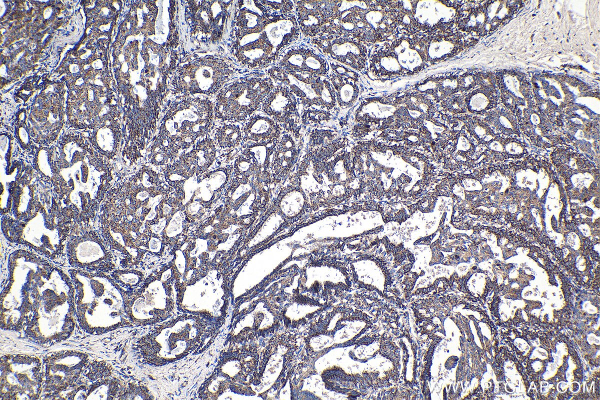 Immunohistochemical analysis of paraffin-embedded human breast cancer tissue slide using KHC1380 (MRPS34 IHC Kit).