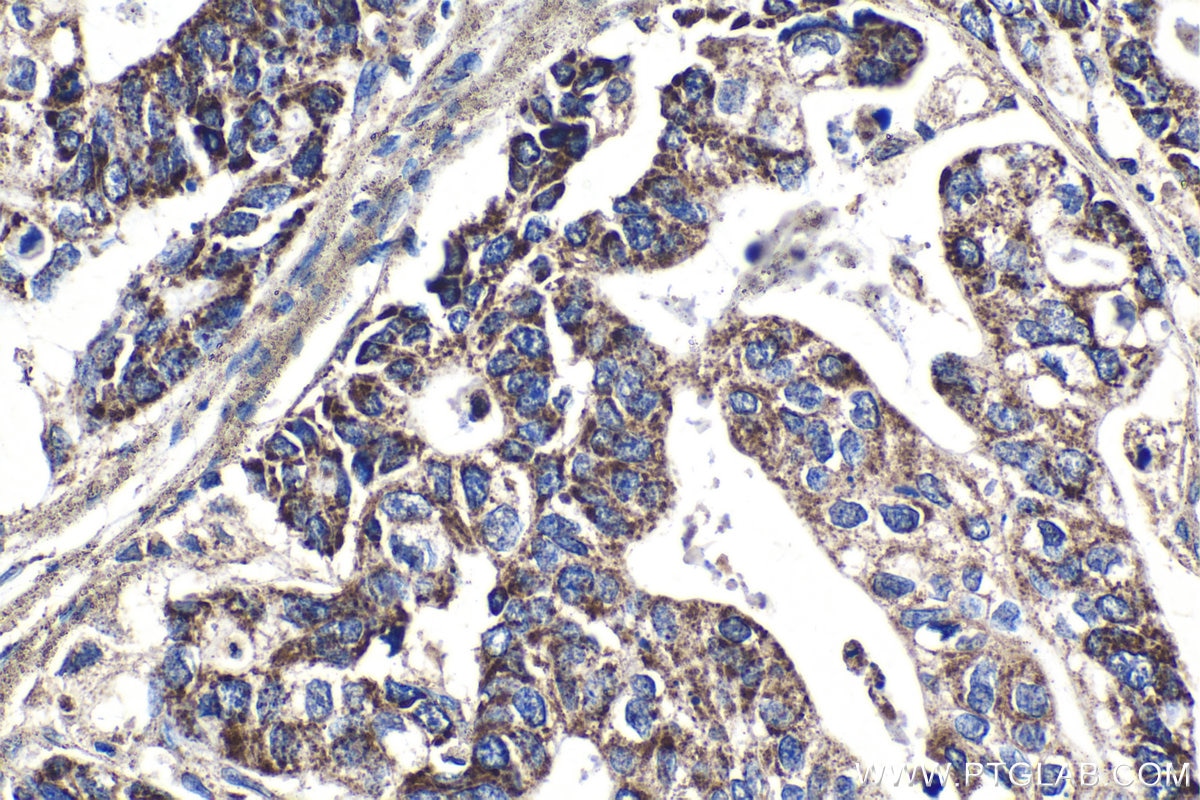 Immunohistochemical analysis of paraffin-embedded human stomach cancer tissue slide using KHC1380 (MRPS34 IHC Kit).