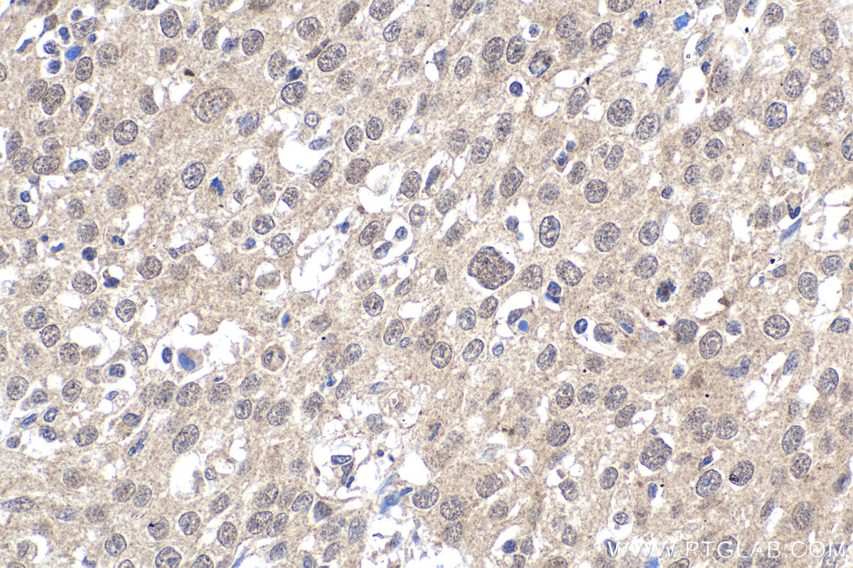 Immunohistochemical analysis of paraffin-embedded human cervical cancer tissue slide using KHC1865 (MRTFA/MKL1 IHC Kit).